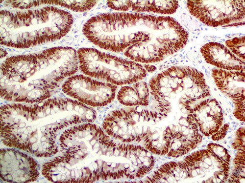CDX2 Antibody Immunohistochemistry on a FFPE Colon Adenocarcinoma Tissue